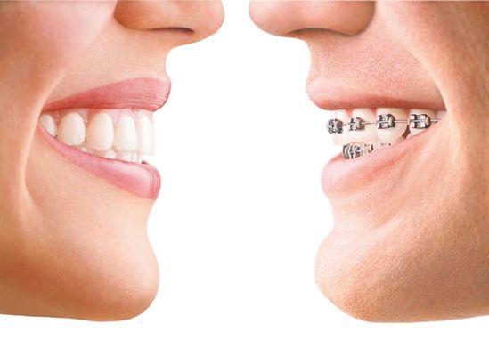 Invisalign vs Braces