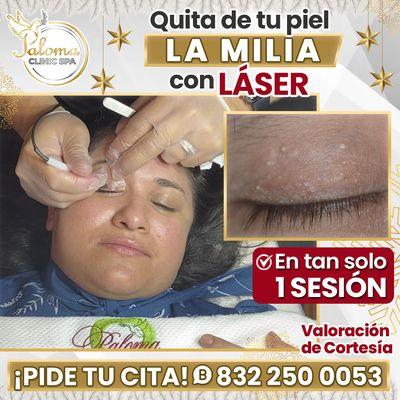 Remueve con Láser: Milia, Mezquinos & Melasma con Paloma Clinic Spa Vive para ti, quiérete!