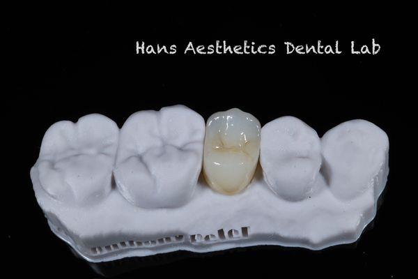 Hans Aesthetics Dental lab Aesthetics Porcelain veneers, cosmetic dentistry Aesthetic dental lab nyc dental lab feldspathic veneers