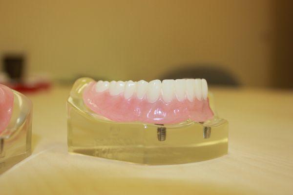 Lower denture with two implants!