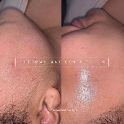 Advanced dermaplane facial.