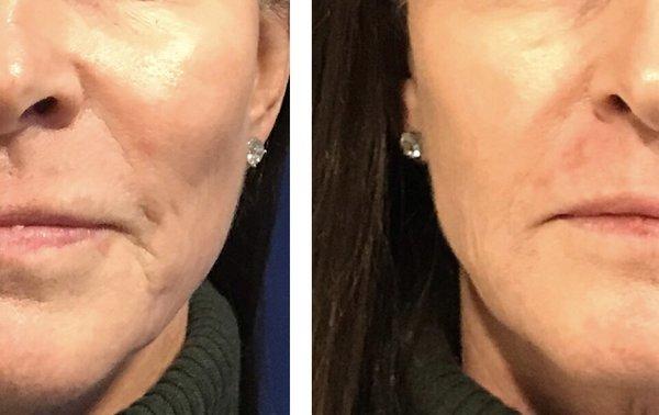 Before and After Juvederm filler injections