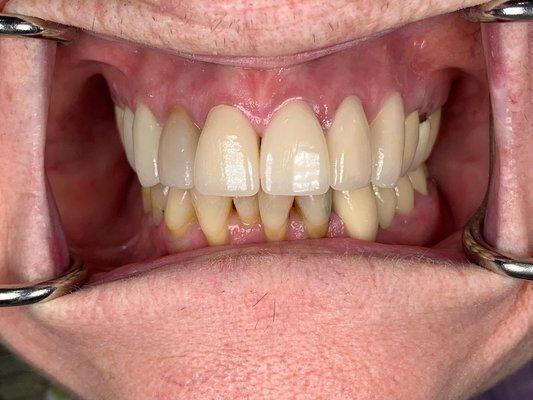 Teeth after new crowns