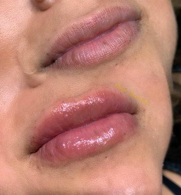 Needles Lip Filler