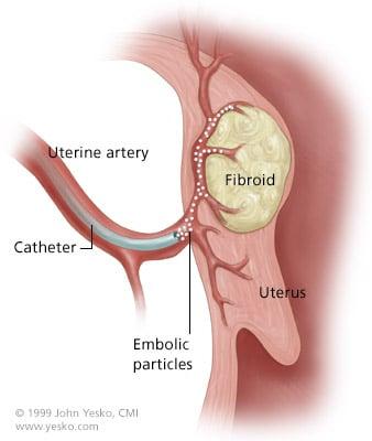 Treatment of Uterine Fibroid Tumors