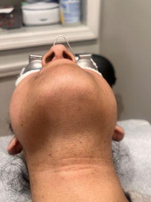 After laser hair removal of the front of neck.