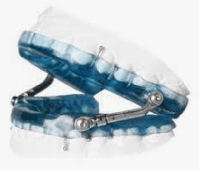 Herbst Oral Appliance to treat Obstructive Sleep Apnea