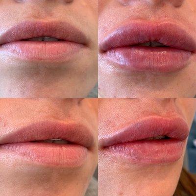 Lip augmentation