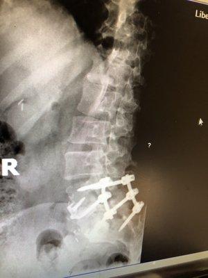 Hardware in lower spine.