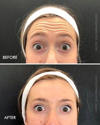 Botox in the forehead. 2 weeks post injection. Great transformation!