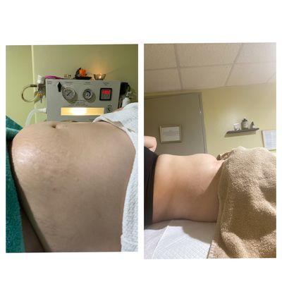 After the series of colonics, clients abdomen has been relieved of bloating