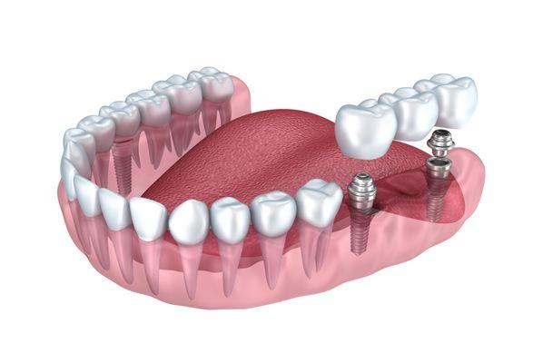 Dentures and Bridges for your Comfort