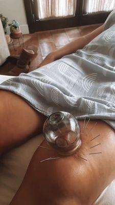 Cupping and acupuncture