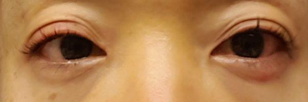 Swollen Itchy Red Eyelids- Undisclosed Glue used for Classic Eyelash Ext. Removed lashes & req Emergency Steroid trmts from Ophthalmologist