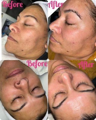 Before and after 1 Diamond Peel facial! Your face will look brighter.