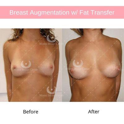 Before and after breast augmentation with fat transfer on 20 year old woman interested in a natural breast enlargement, without implants.