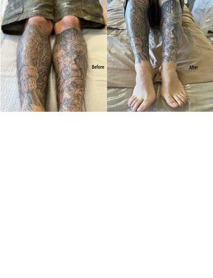 Wax and hair removal on tattooed legs.