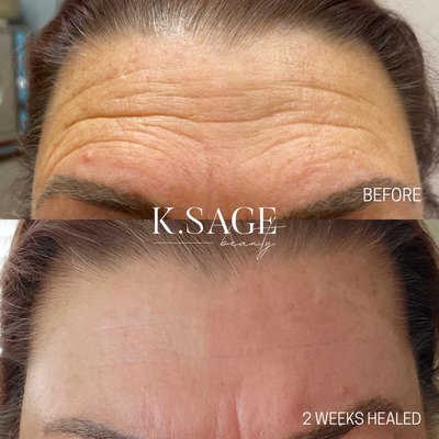 Plasma Skin Tightening