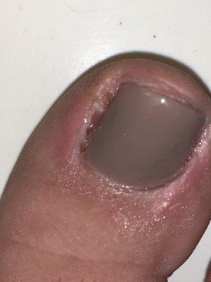 Right toe