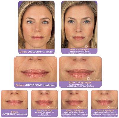 Juvederm® can help soften and fill fine lines and wrinkles for up to  1 year! Call now for your free consultation.