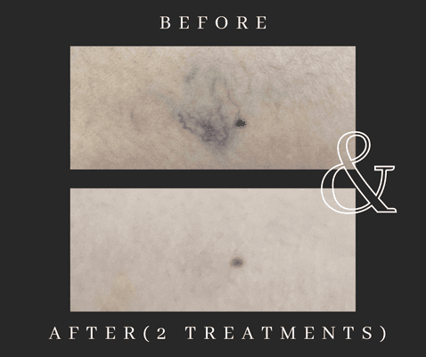 Spider Vein Removal