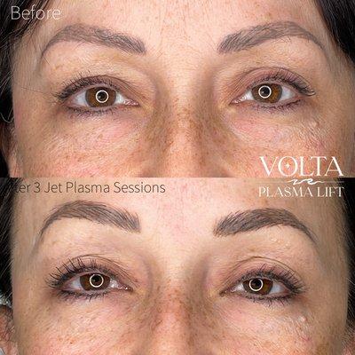 Jet Plasma Non-invasive skin tightening & brightening