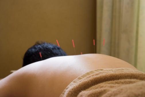 Acupuncture Treatment