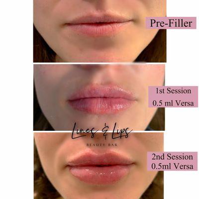 Lip Progression