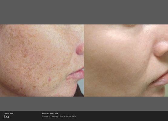 Laser treatments show before and after improvement of pigment