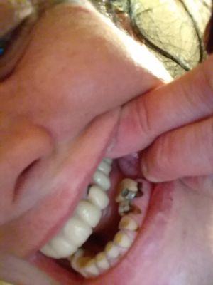 1-year old upper bridge showing separation and how it smashed my lower teeth.  Bridge is falling off!  This is what I got for $13,000.