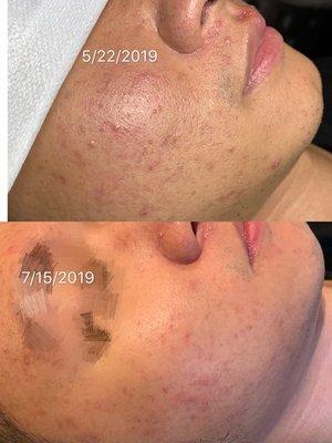 Chemical peel + extraction