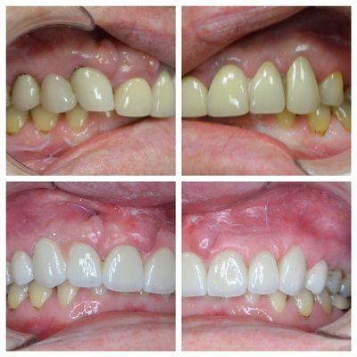 Gum lift procedure to compliment porcelain restoration