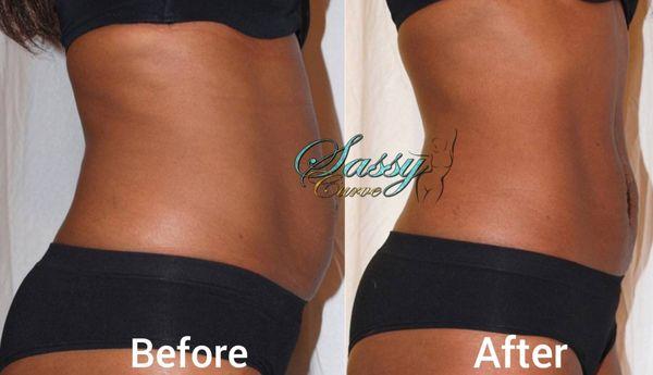 Instant results in the abdomen area