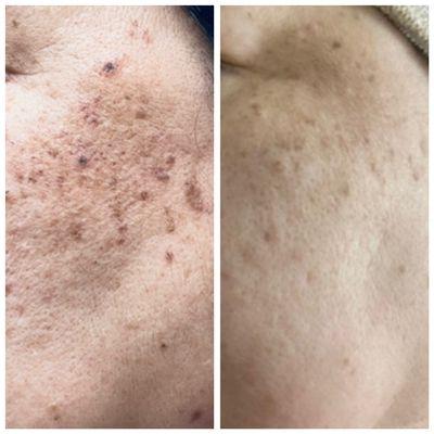 IPl treatment before and after