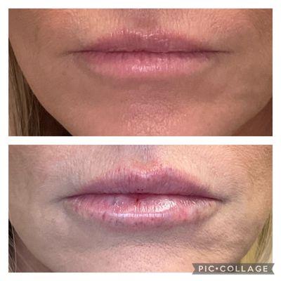 One syringe of #lipfiller for those perfect, pouty lips. #lips #dermalfiller #lipfillers