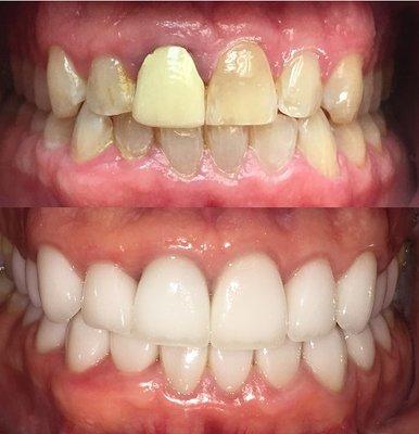 One of Dr. Myers' before and after cosmetic cases utilizing his training and education with cosmetic dentistry!