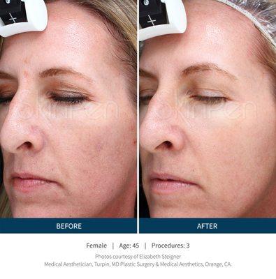 Before and After SkinPen Microneedling 3 Procedures