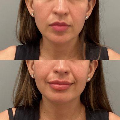 BEFORE+AFTER: Gorgeous pouty lips injected by our lovely RN Laura!