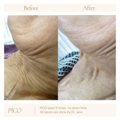 PICO LASER FOR NON INVASIVE SKIN TIGHTENING