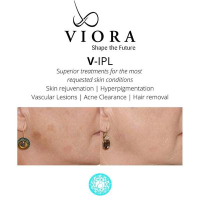 Viora IPL  safely removes unwanted sunspots.