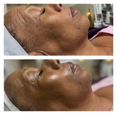 Carboxy + VTox treatment before & after