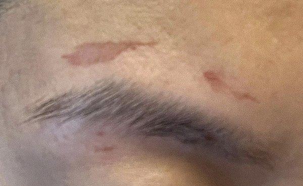 Damage skin from waxing