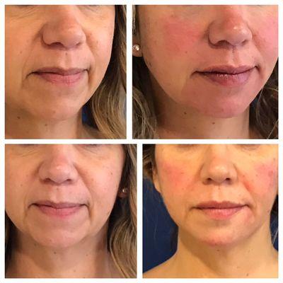 Before and After Restylane filler injections to sculpt the face