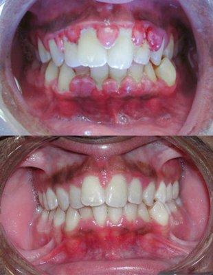 Happy patient before and after