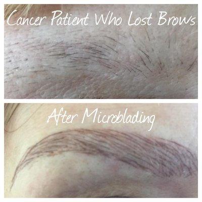 This is a cancer patient who completely lost her brows.  This is round one of Microblading.