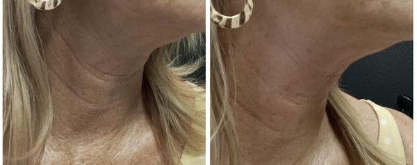 RF/IPL skin tightening treatment