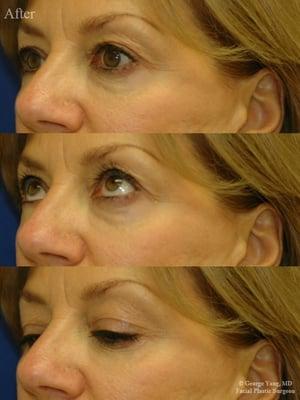 55 yo woman: Restylane injections to blend away her eyebags by filling her tear troughs & orbital rim hollow and lift her cheek.