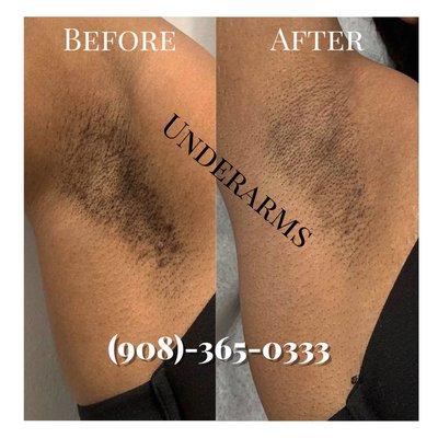 Laser Hair Removal