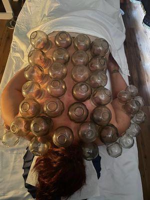 Cupping session