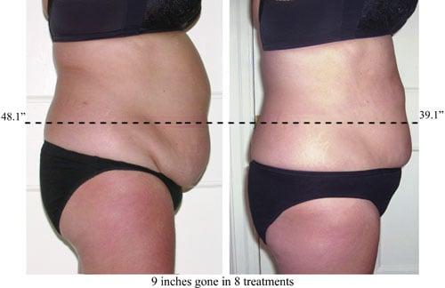 8 visits of laser like lipo.  Changes to diet and exercise were taken to have this great accomplishment of 9 inches lost.